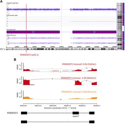 Uniparental disomy for chromosome 1 with POMGNT1 splice-site variant causes muscle-eye-brain disease